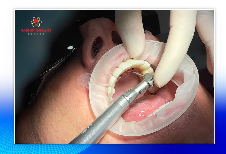 best all on 6 implants